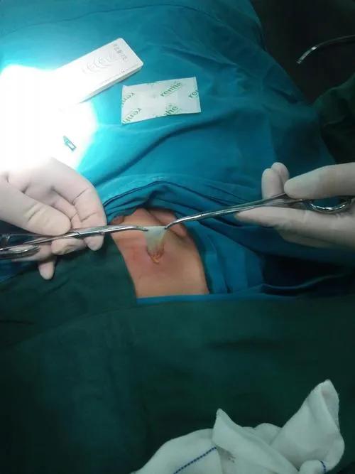 发现宝宝患腹股沟疝气怎么办,发现疝气的孩子怎么照顾