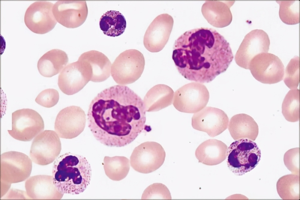 血常规可以发现癌症吗,血常规检查能发现癌症吗