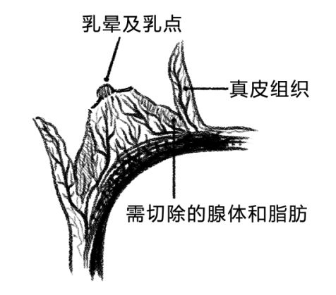 乳房太大?需要做巨乳缩小手术吗?