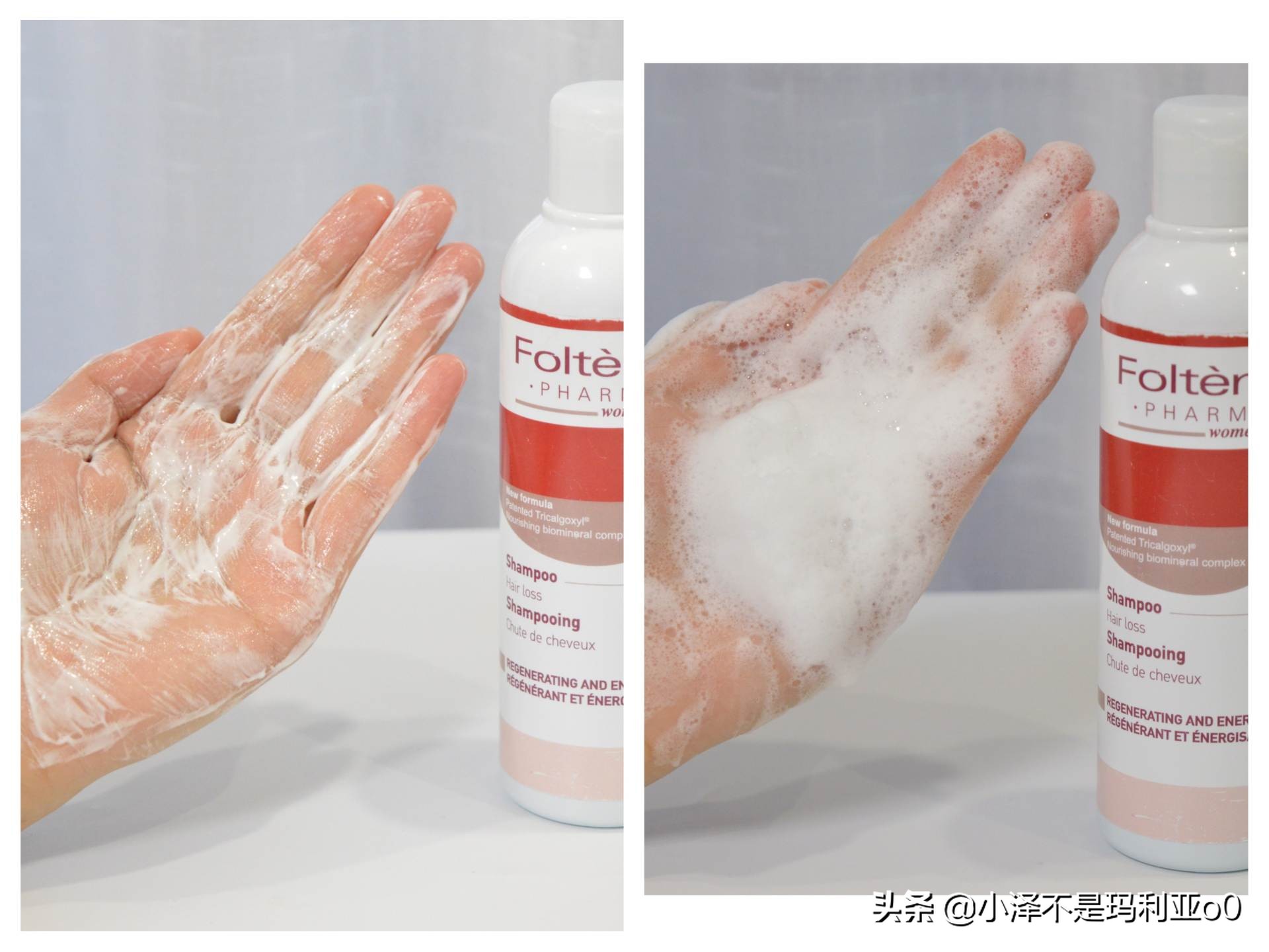 额头秃发际线后移适合什么洗发水,拯救发际线的洗发水