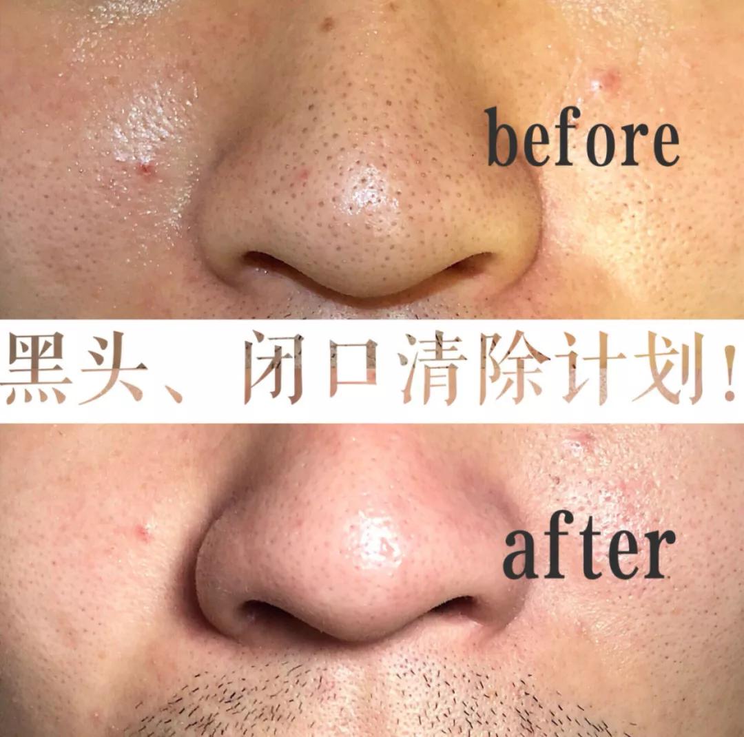 黑头闭口连根拔起,黑头粉刺连根拔起留坑