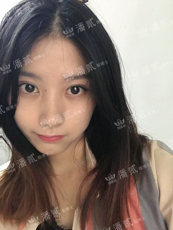 肿眼泡抽脂肪埋线双眼皮效果,肿眼泡割双眼皮长脂肪