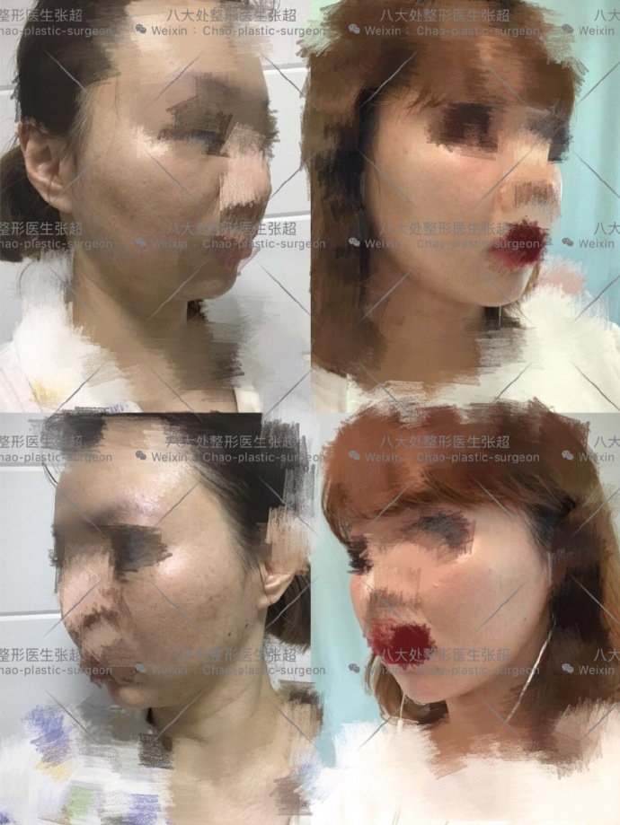 八大处整形张超,八大处张超最新视频