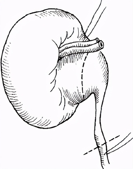 严重肾积水可以保守治疗吗,严重肾积水需要治疗吗