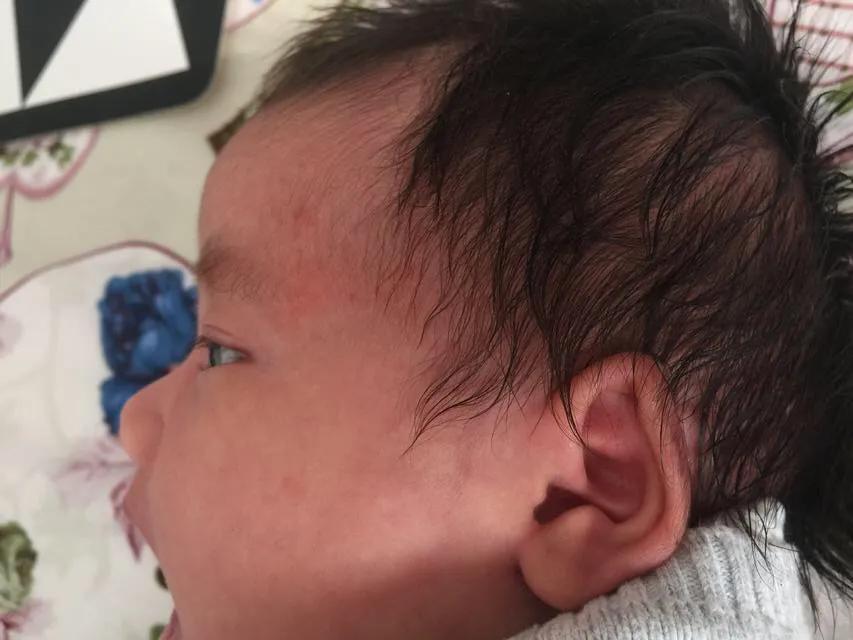 宝宝得湿疹妈妈怎么忌口,宝宝湿疹怎么办宝妈分享