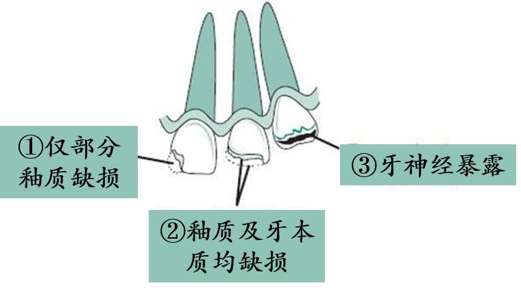 牙齿断了把牙根拔出,牙齿断了拿另一半能补吗