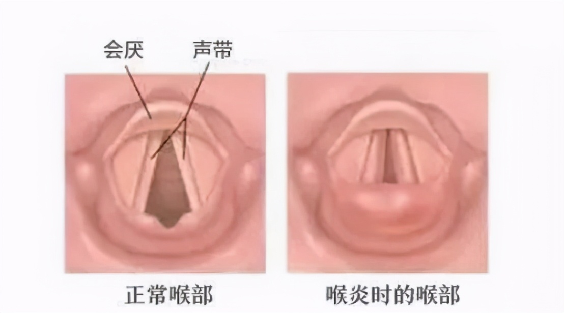 以为孩子只是平常的小感冒,以为孩子只是普通感冒