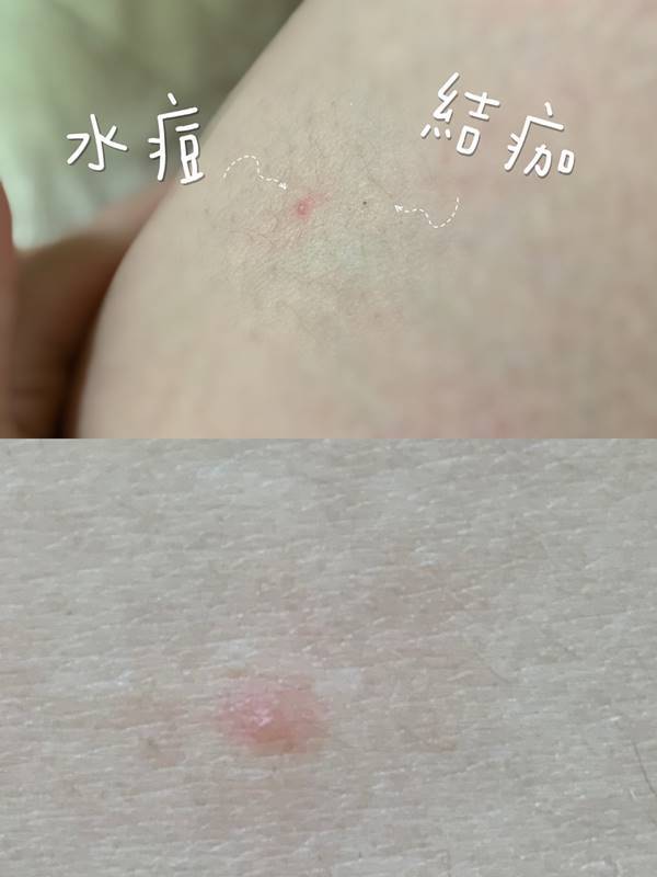 长水痘并发脑炎怎么办,9岁男孩急性荨麻疹是出水痘么