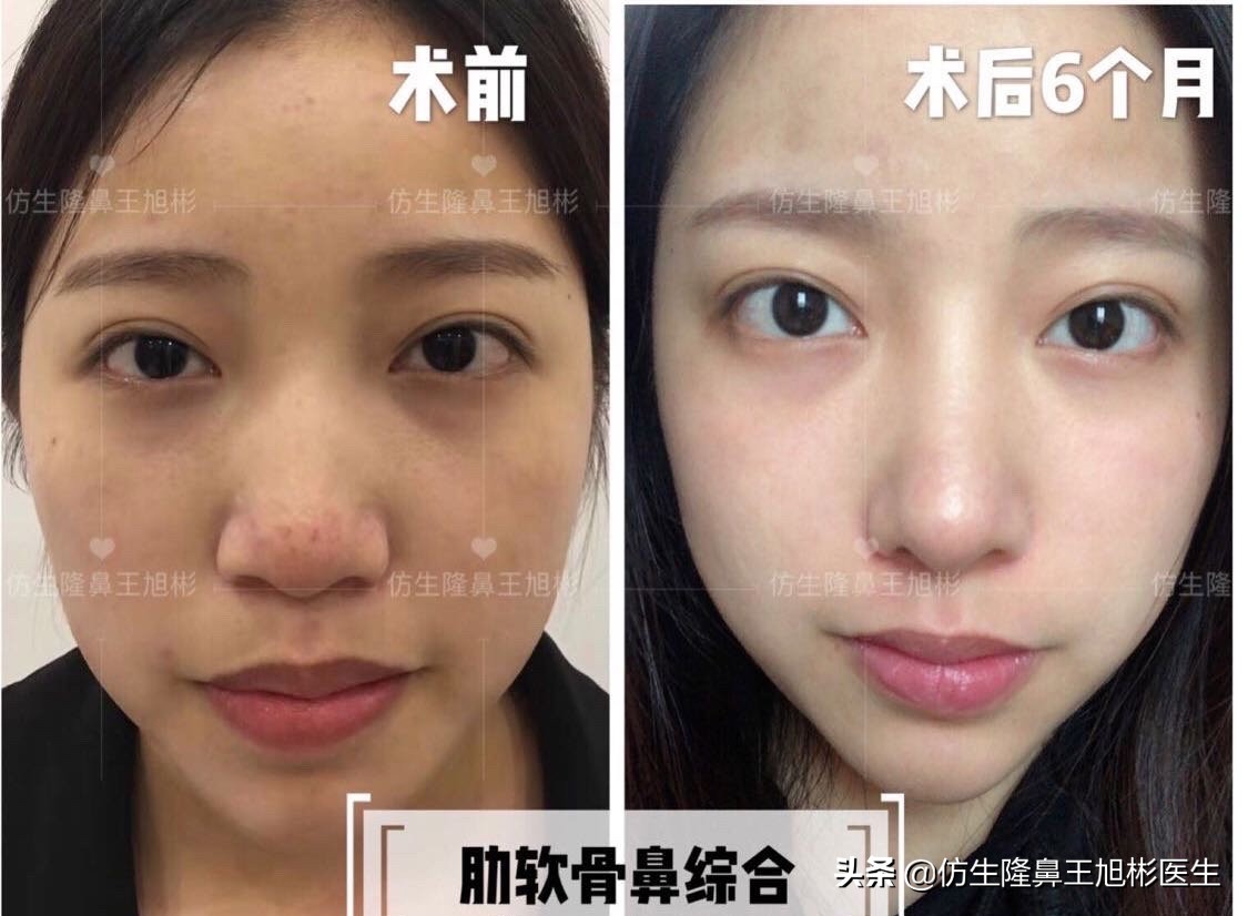 短鼻延长的最佳方法,短鼻修复前后对比案例