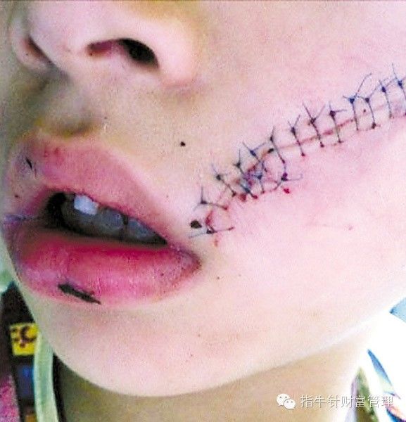 花露水遇火孩子烧伤,小孩用花露水有什么危害