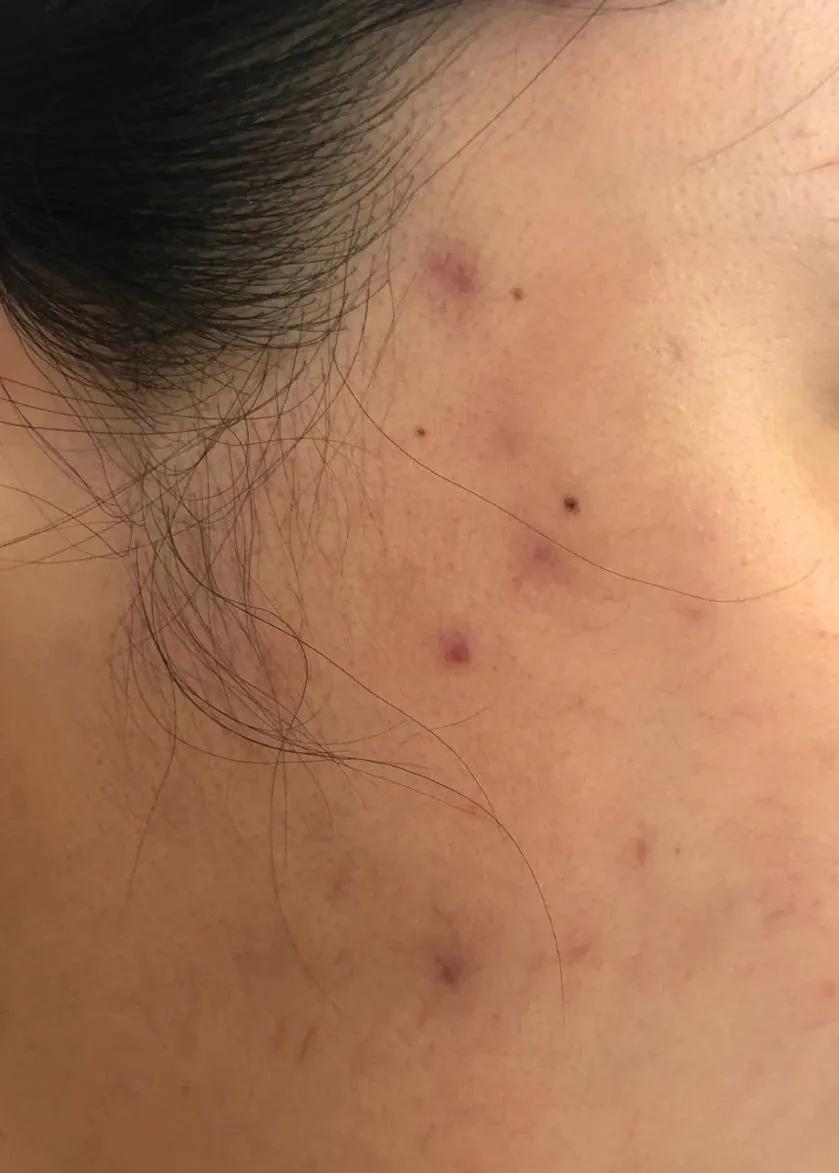 女子在美容院打溶脂针后续,女子打减肥针3天后皮肤溃烂