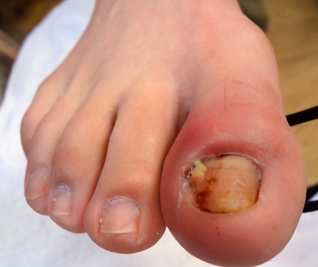 甲沟炎处理视频动画,沉浸式处理甲沟炎