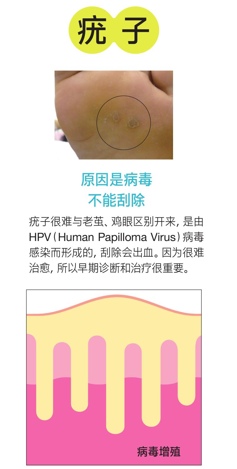 脚底的老茧怎么才能根治,老茧下的鸡眼