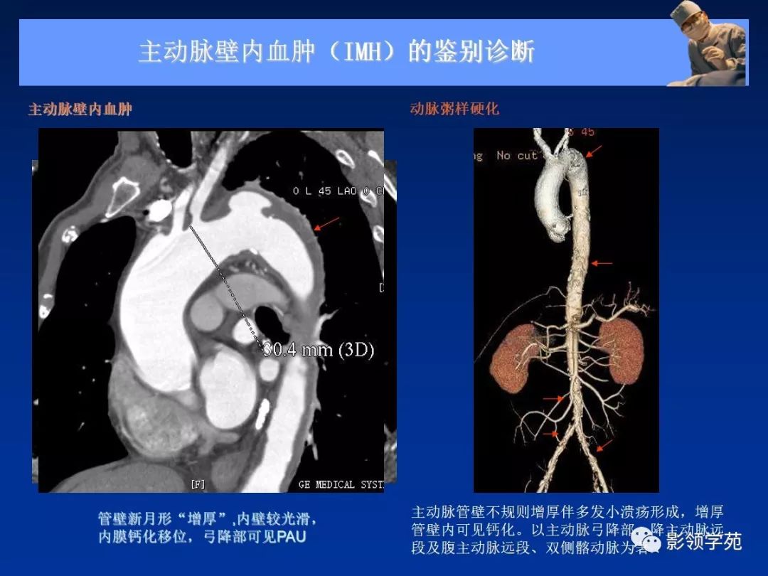 主动脉夹层壁间血肿如何鉴别,主动脉夹层血肿溃疡