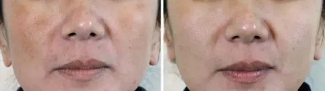 治皮肤褐斑用什么中药膏,青褐斑涂什么药