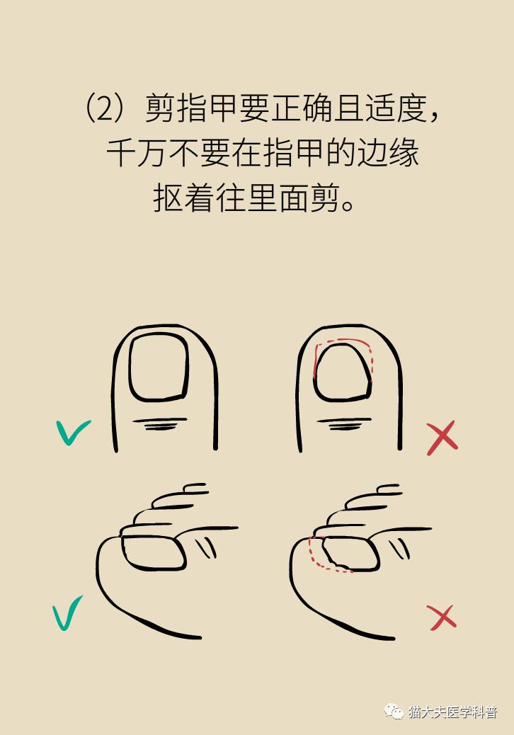 脚趾甲往肉里长怎么治除根,脚趾甲长在肉里面治疗视频