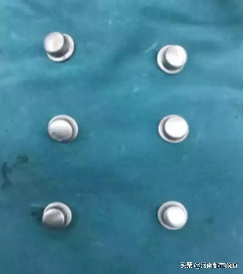 小伙反复头晕查出脑瘤,男子持续头痛竟是脑内有炸弹