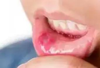 口腔溃疡不用药几天好,口腔溃疡吃点它立马好