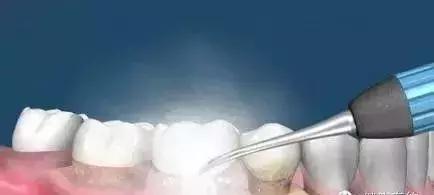 一颗蛀牙惹大祸,竟引发心脑肺肝肾五大器官衰竭!男子命悬一线