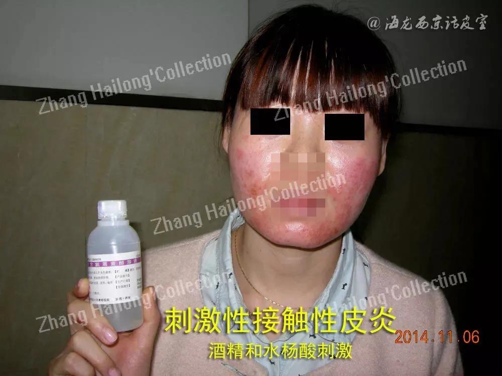 常见的脸部皮肤病有哪些,面部皮肤病辨别图解