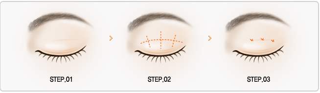 韩国双眼皮手术真实感受,韩国最近新出的医美项目