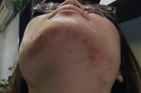 皇家雨燕教你痘痘肌の正确保养方式