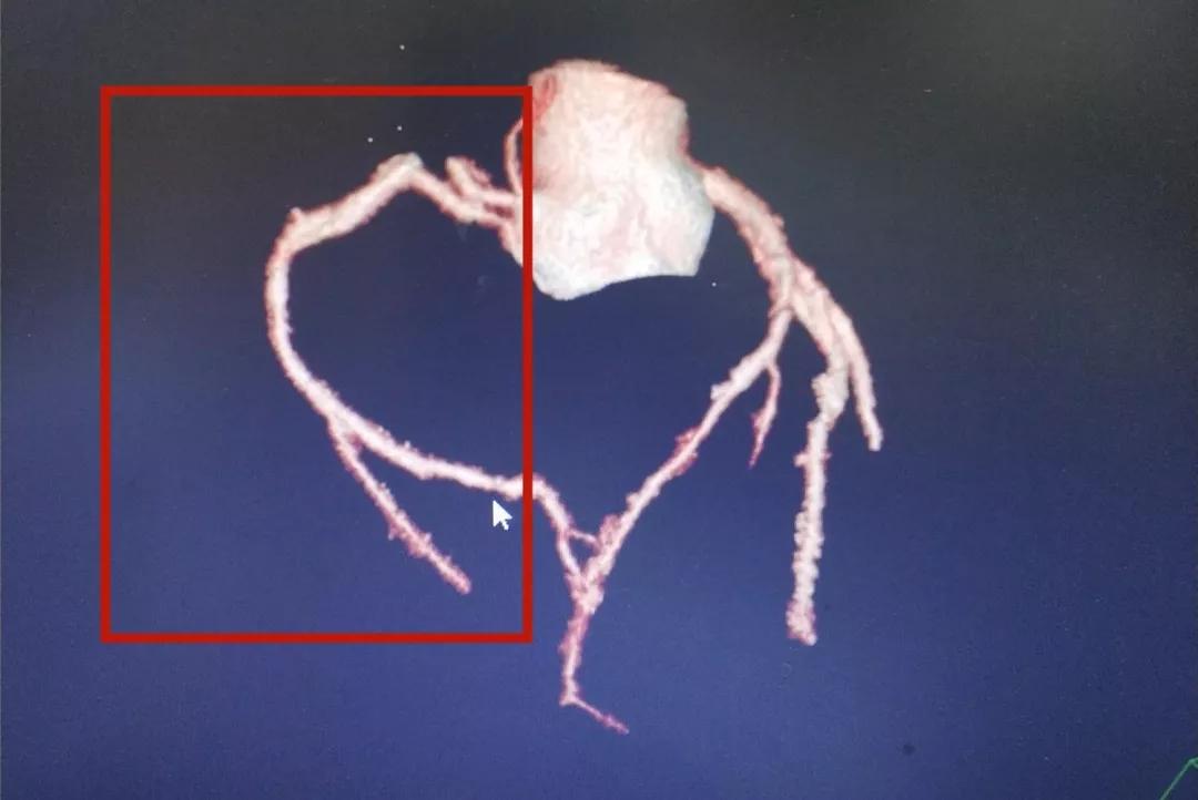 右冠状动脉闭塞多年,右冠状动脉慢性闭塞怎么治疗