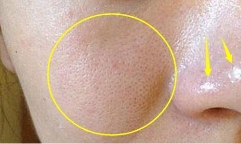 清理黑头痘痘的治愈过程,祛痘痘痘印黑头用什么好