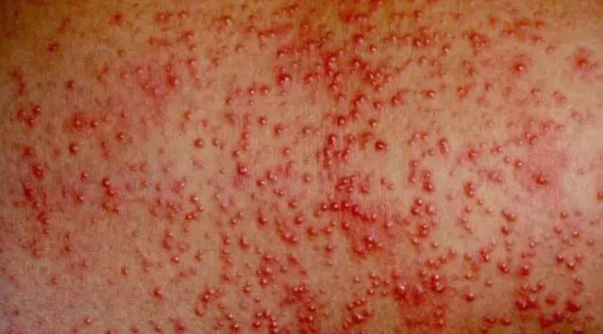 宝宝脂溢性湿疹可以涂什么药膏,宝宝湿疹脂溢性皮炎