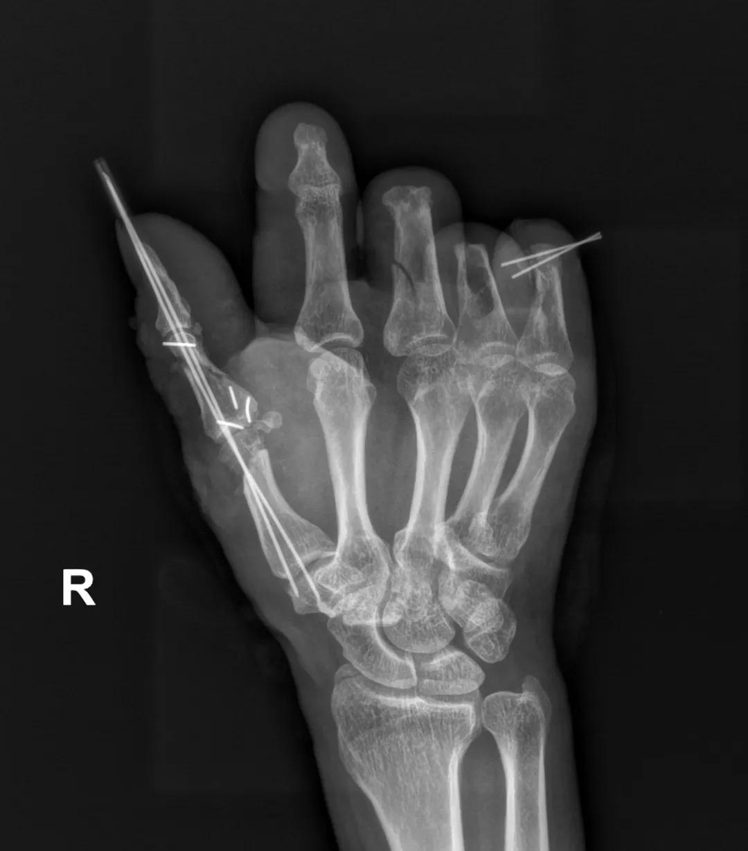 手指被机器绞掉肉后怎么恢复,右手全部被机器绞断算几级伤