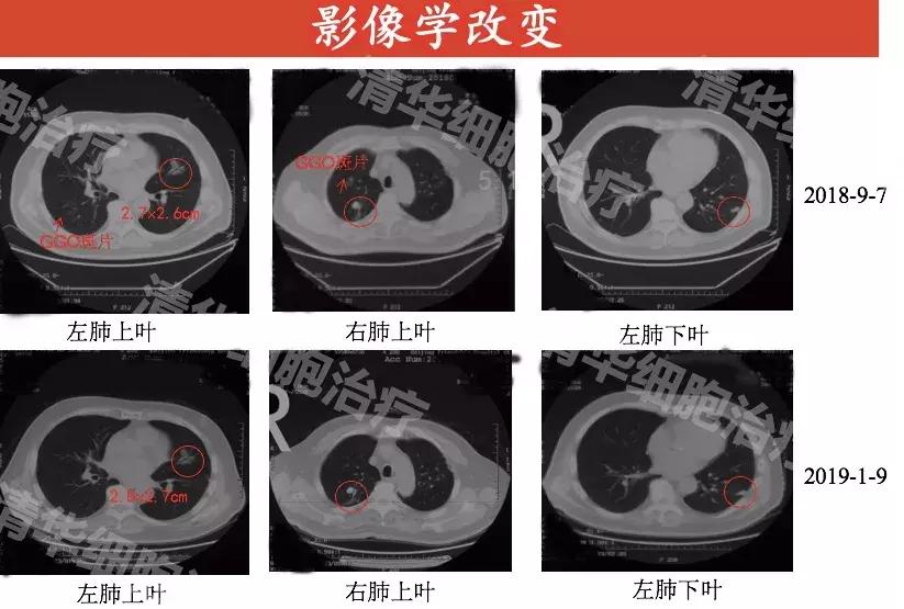 nkt免疫治疗哪些癌症,nkt癌症新疗法