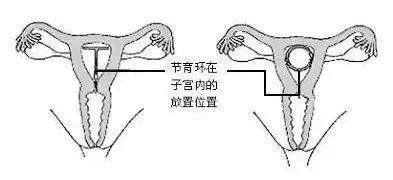 节育环的保质期是多长时间,节育环有保质期到期不取危害大