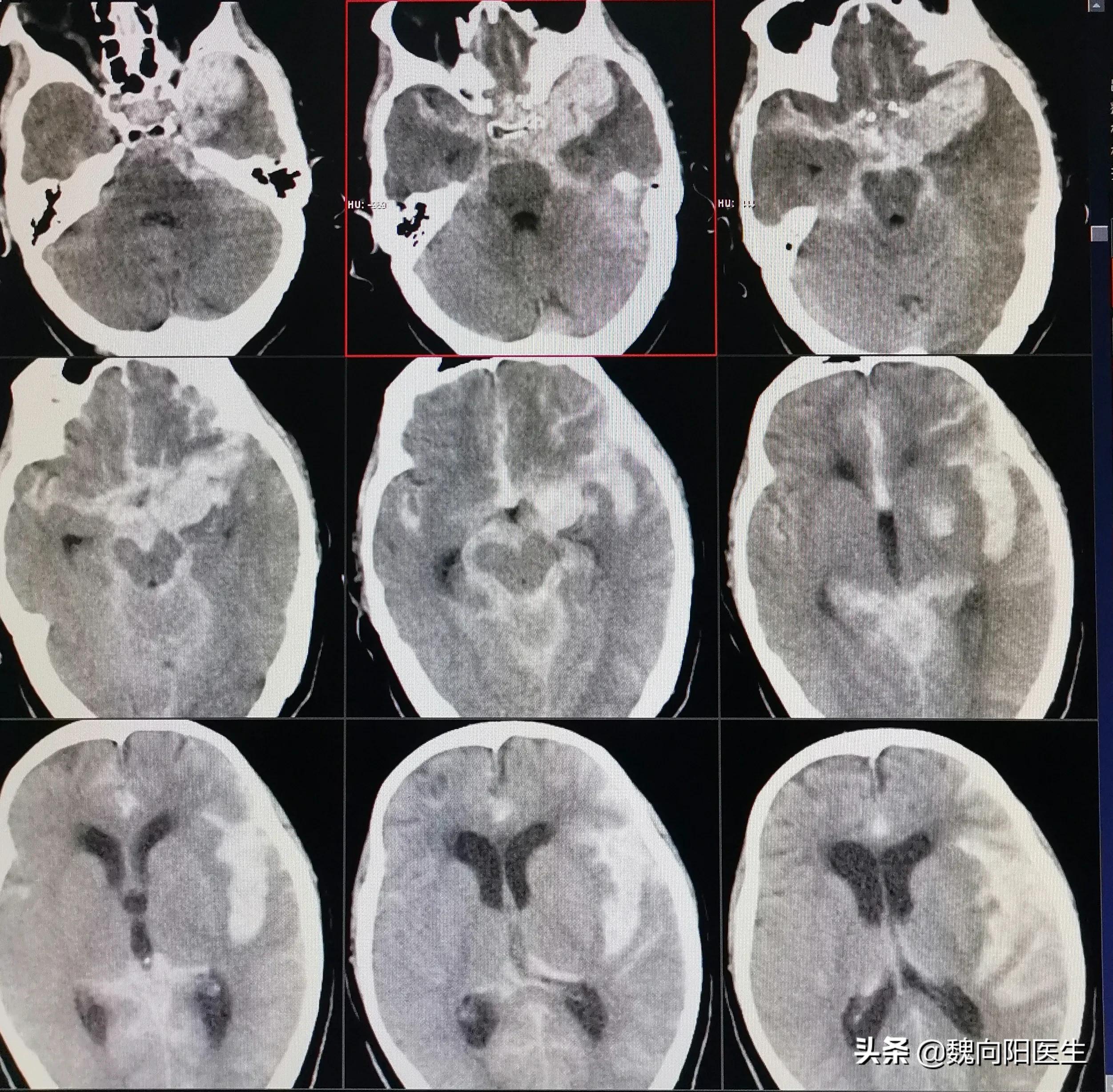 脑动脉瘤破裂后昏迷开颅,颅内动脉瘤破裂出血昏迷不醒