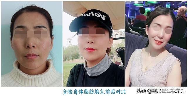 太阳穴凹陷与额头有明显棱角面相,太阳穴凹陷的脸型有长的好看的吗