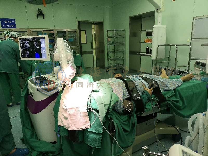 治疗精神分裂症的微创手术,治疗精神分裂症的神经调控手术