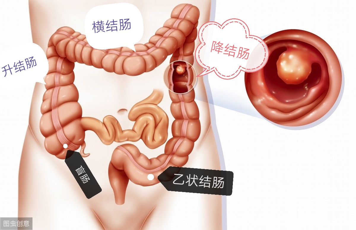 心衰病人便秘可吃四磨汤吗,心衰导致便秘的科普