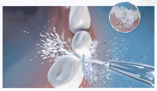 烤瓷牙基底冠如何清洁不崩瓷,烤瓷牙咬合面崩瓷必须重做吗