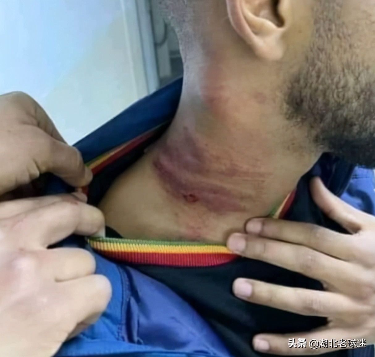 *力暴**足球再现!门将飞踹前锋头部,脖子上全是伤,还留下大血洞