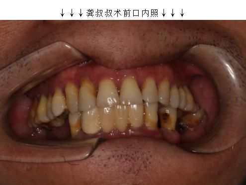 缺牙处牙槽骨萎缩邻牙受影响,60岁老人缺牙怎么治疗好
