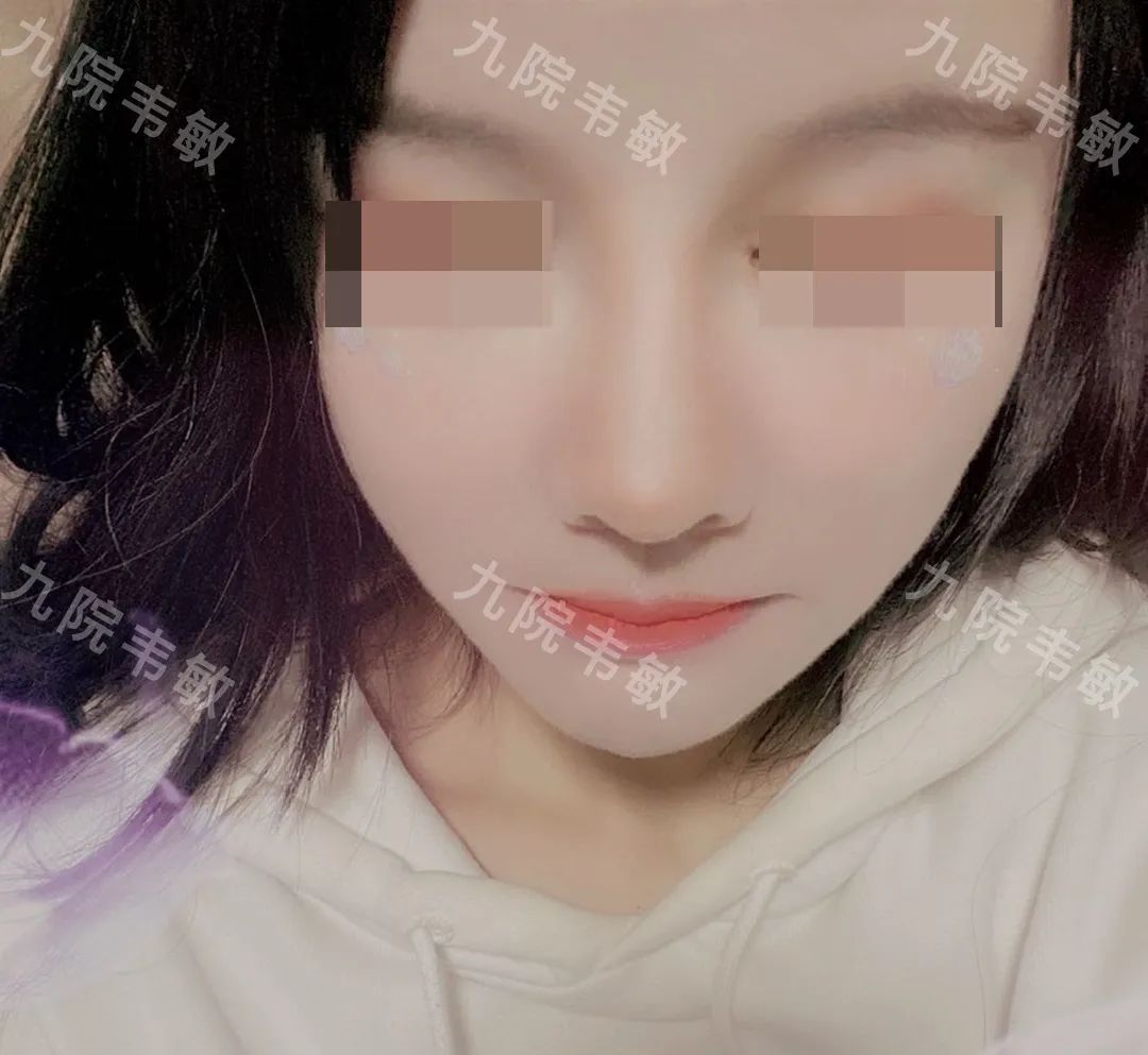 我终于摆脱了扁塌鼻这个颜值“拖油瓶”