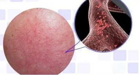 *血丝红**的自救指南,大家快来抄作业