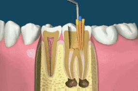 根管治疗补牙齿的时候疼不疼,根管治疗之后补牙齿一般要多少钱