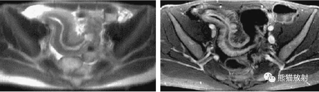 腹部影像图片大全,乙状直肠疼痛位置图片