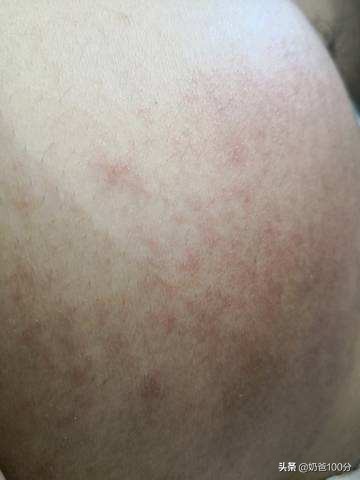 妊娠痒疹是胎毒吗,妊娠痒疹一定要生过之后才会好吗