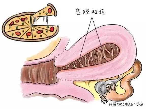 部分宫腔粘连自愈的秘诀,宫腔粘连里面有很多小石头