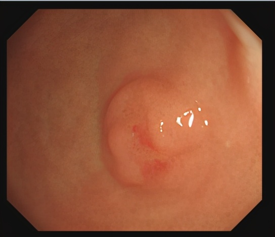 胃肠息肉是癌吗,长了结肠息肉会有什么症状