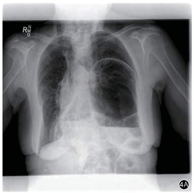 吃过饭就胸闷是冠心病吗,冠心病吃饱了为什么总是胸闷