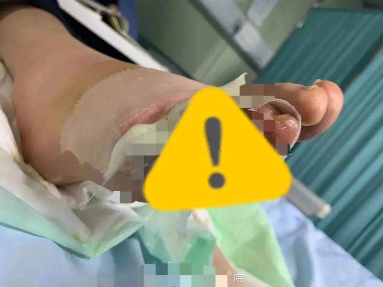 男生脚被烫伤,男生脚冻伤