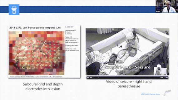 儿童癫痫治愈的真实案例,儿童难治性癫痫有哪些