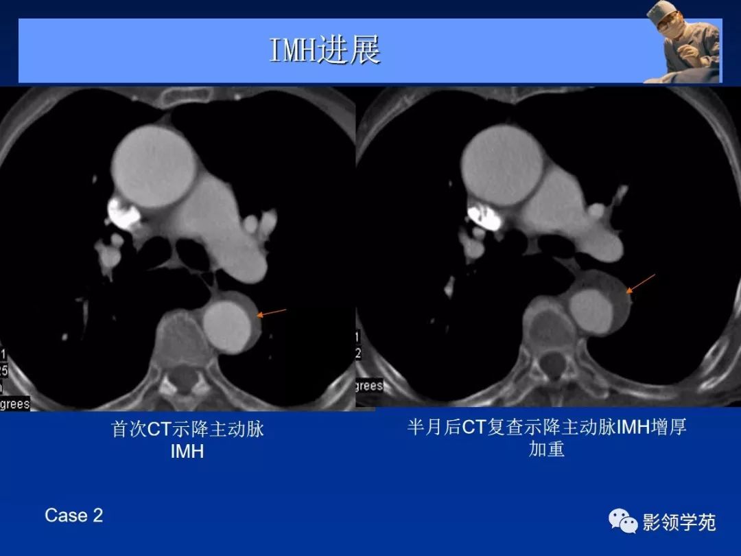 主动脉夹层壁间血肿如何鉴别,主动脉夹层血肿溃疡
